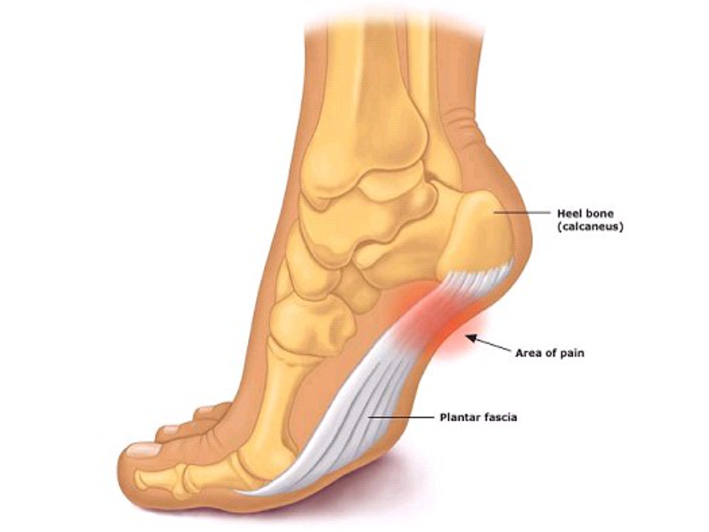 Plantar fascia rupture information