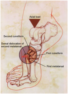 Dorsal dislocation of second metatarsal in Lisfranc Injury