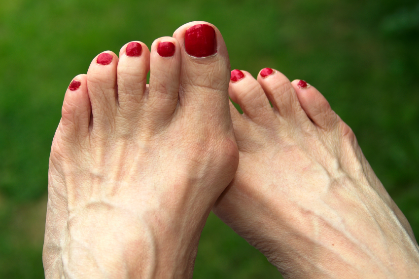 Bunions Atlanta Bunion Surgery American Foot Leg Specialists   Bunions 