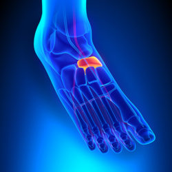 Read more about the article The navicular bone: what every sufferer must know