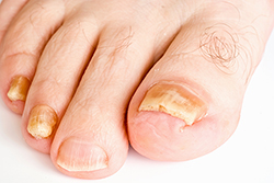 Read more about the article Is Toenail Fungus Painful?