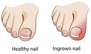 illustration of a healhty nail and an ingrown nail | American Foot & Leg Specialists