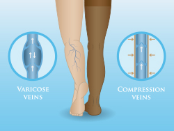 Read more about the article Compression Hosiery