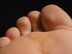 Read more about the article Plantar’s warts: painful and contagious