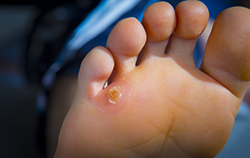 Read more about the article What Causes Callused Feet?