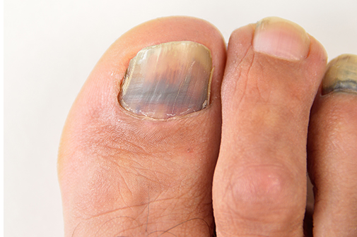 Attention Runners Dont Ignore Blackbruised Toenails American Foot