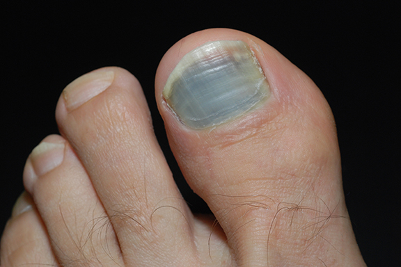 Cyanosis (Blue Hands & Feet): Causes, Treatment & Diagnosis