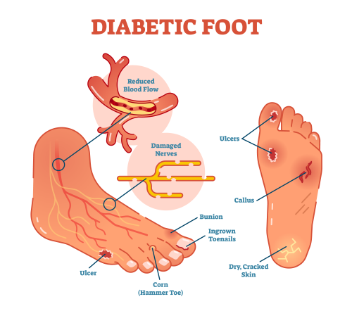 Diabetic Foot Problems Treated At American Foot And Leg Specialist