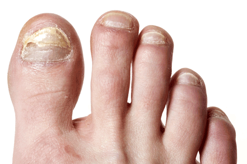Toenail-fungus Toenail fungus