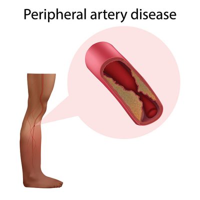 Causes of Peripheral Artery Disease - American Foot & Leg Specialists