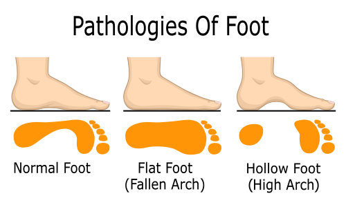 flat footed definition