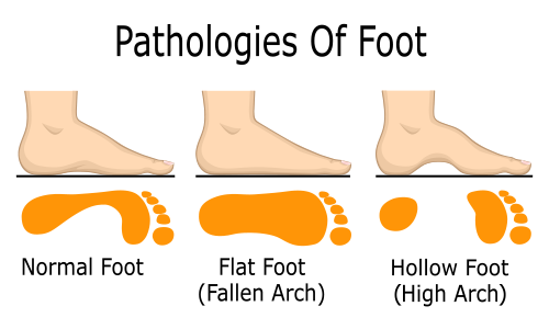 flat footed meaning