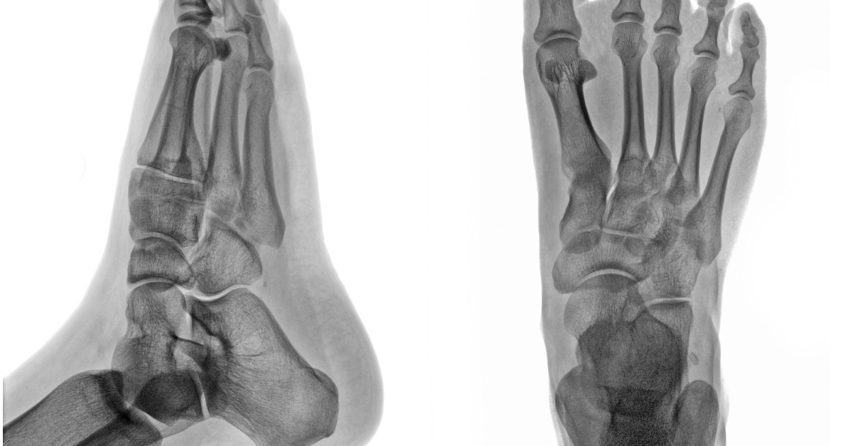 Read more about the article Common Fractures to the Foot & Ankle
