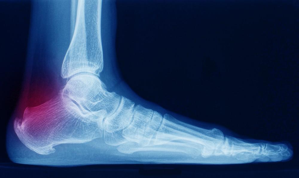 Read more about the article Is Your Heel Pain a Heel Spur?