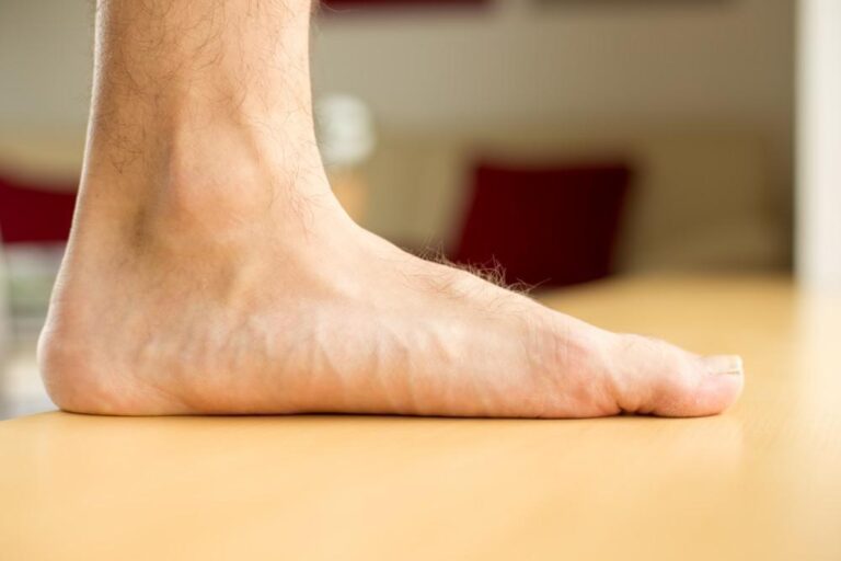 Read more about the article Flat Feet – What You Need to Know