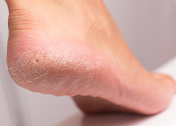 Read more about the article What To Do About Calluses