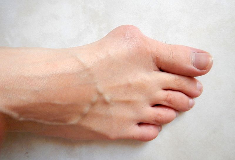 You are currently viewing What You Need to Know About Bunions