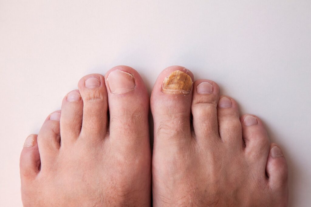 How To Treat Toenail Fungus American Foot & Leg Specialists