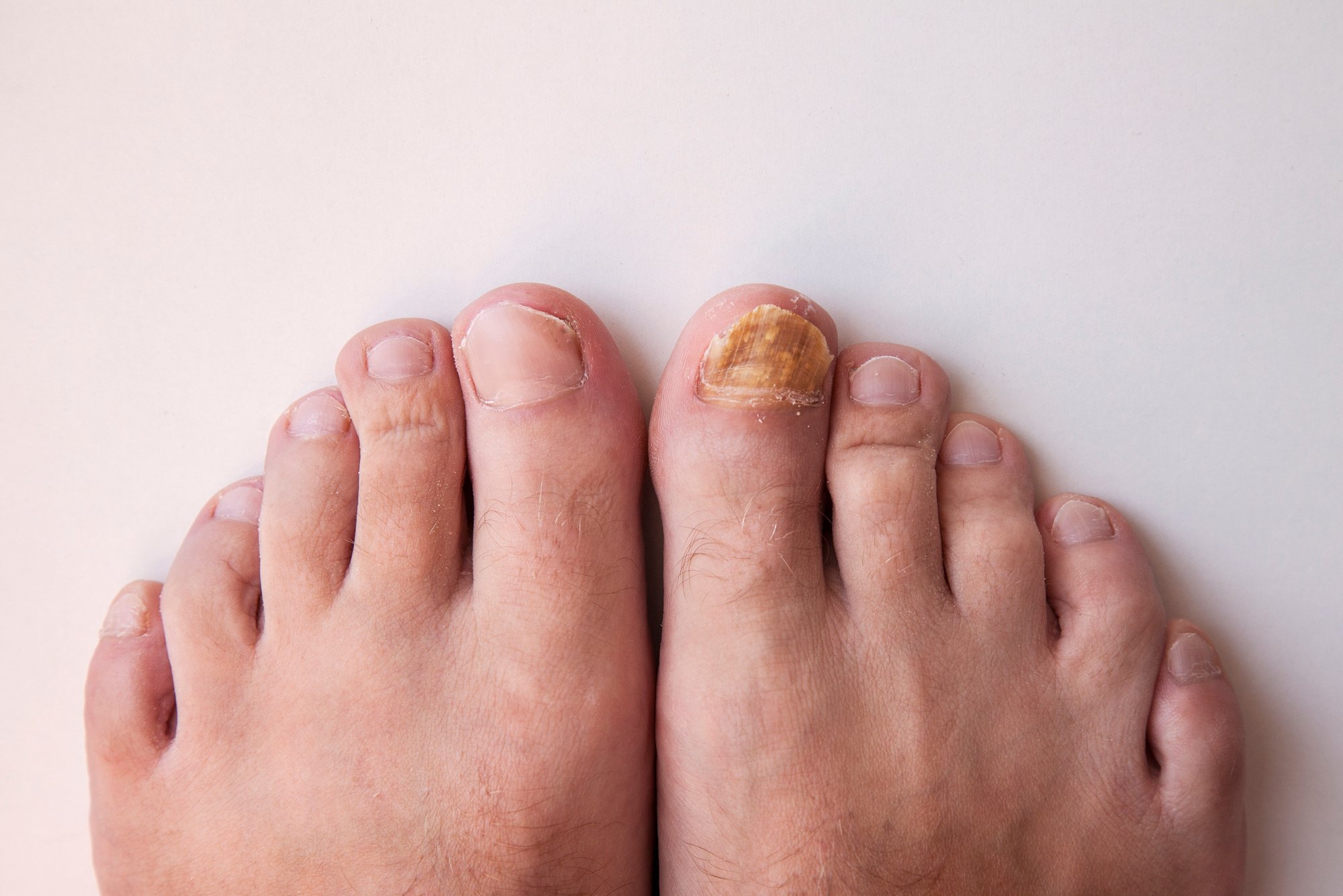 You are currently viewing How To Treat Toenail Fungus
