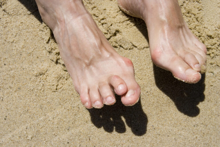 Read more about the article Do I Have Hammertoe?