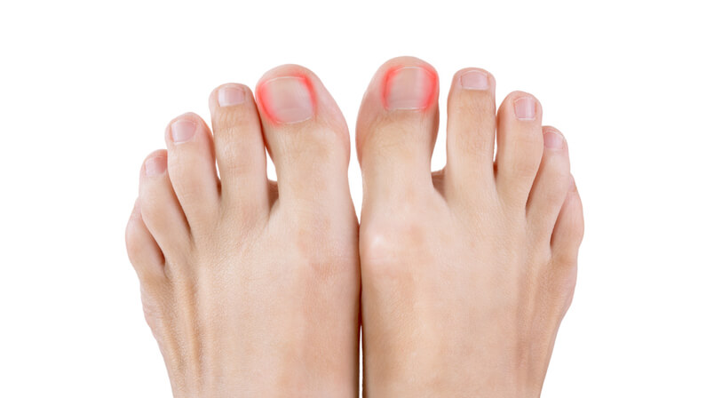 Read more about the article When You Should See A Doctor For The Ingrown Toenail